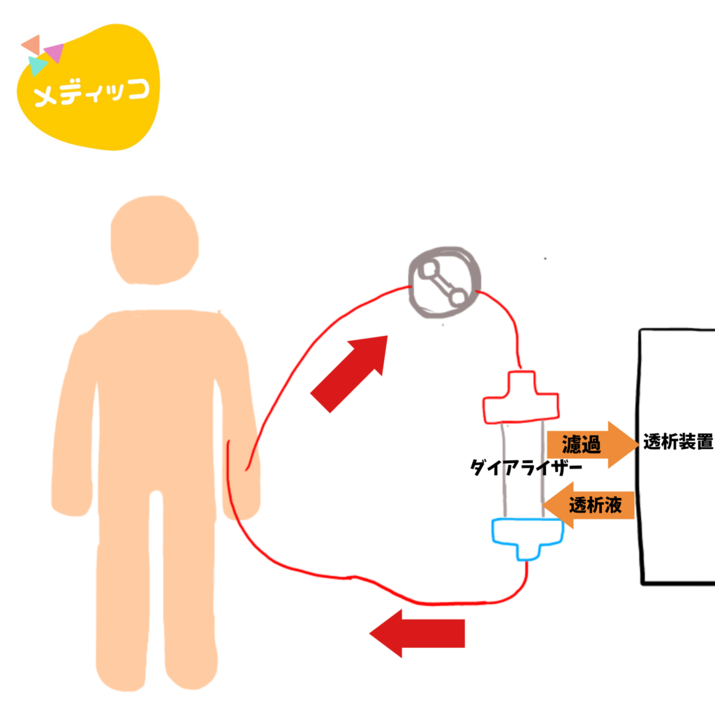 血液透析 | メディッコ
